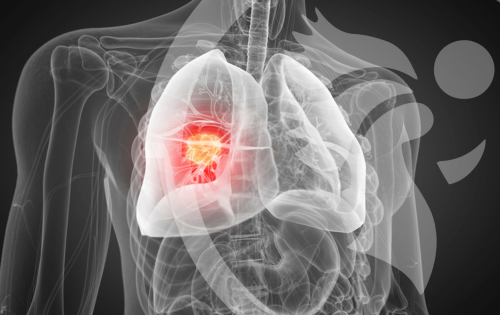 cancer de pulmon tratamiento